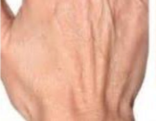 Profhilo-hands_2-before