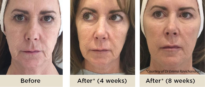 RR_Profhilo_before_after6
