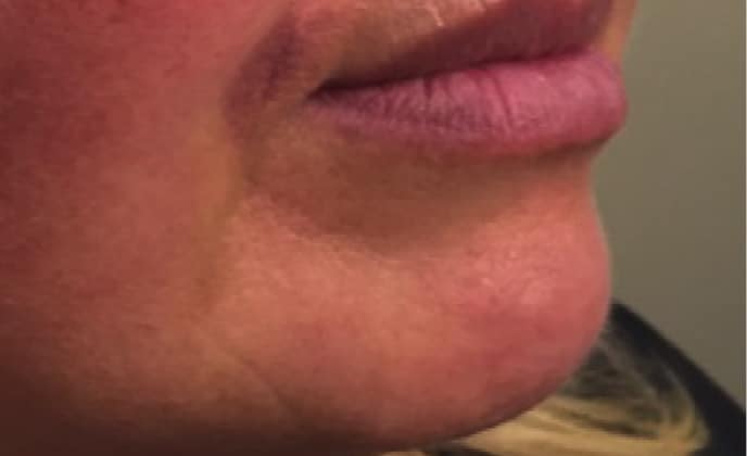 Non-surgical-1-after