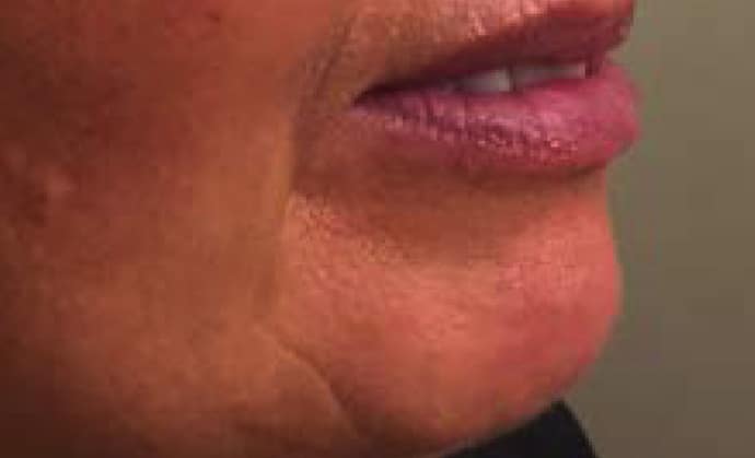 Non-surgical-1-before