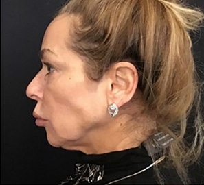 Non-surgical-10-before