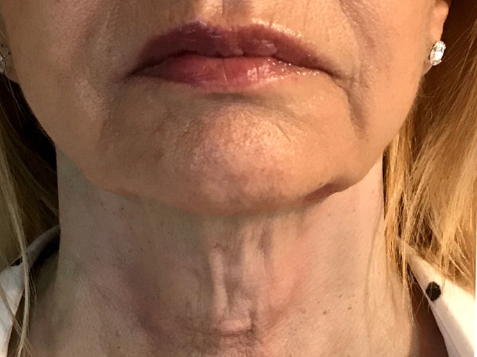 Non-surgical-12-before