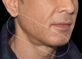 Non-surgical-13-after