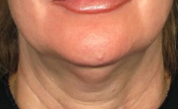 Non-surgical-4-before