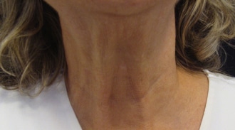 Non-surgical-6-after