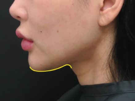 Non-surgical-9-after