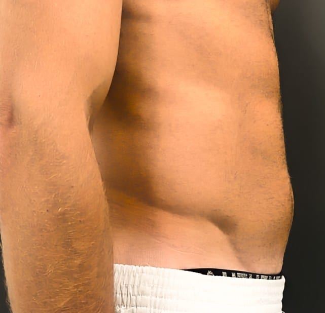 Abdominal-Dr.-Virginia-Benitez-Roig-1-After-6-sessions