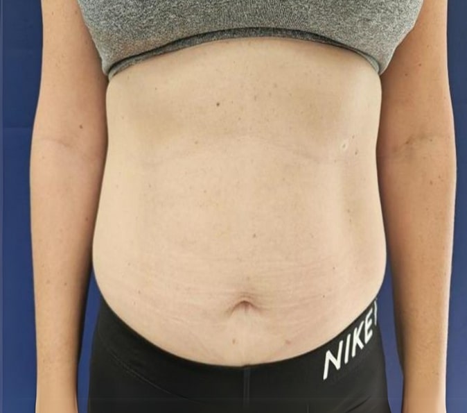 Abdominal-Sofwave-Clinic-after-p229-1