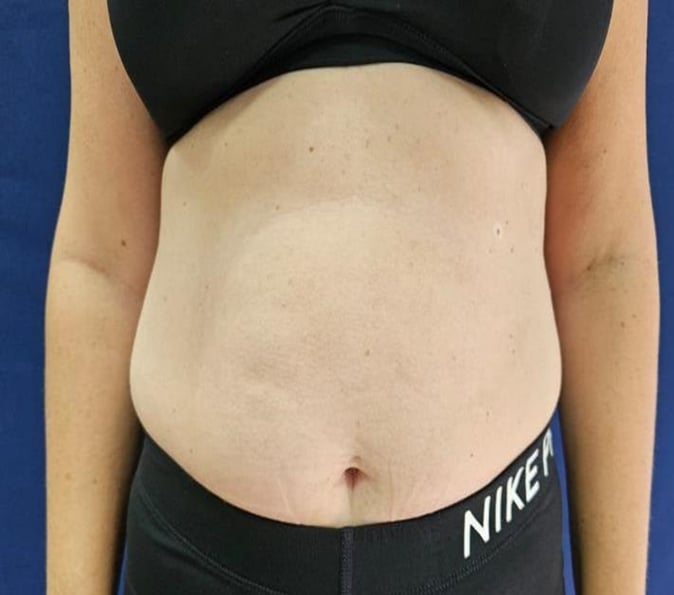 Abdominal-Sofwave-Clinic-before-p228