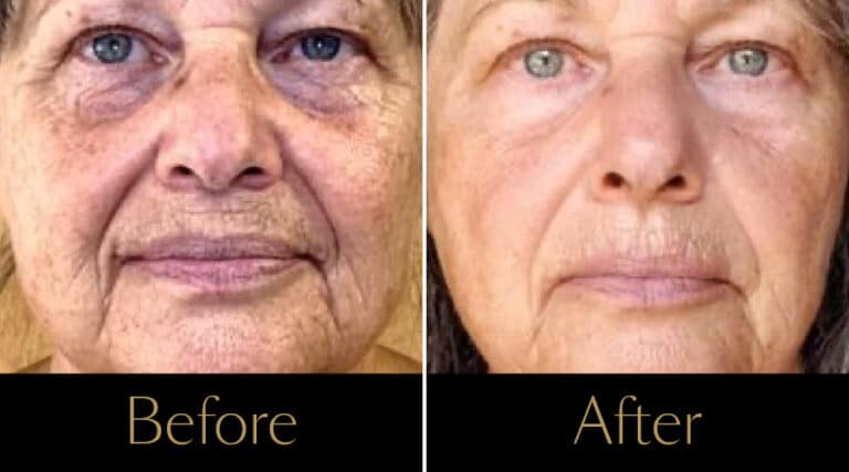 advatx-before-after16