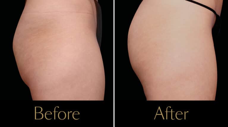 neo-beforeafter