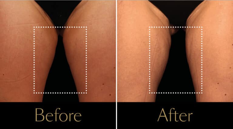 neo-beforeafter3