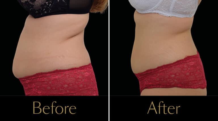 neo-beforeafter5