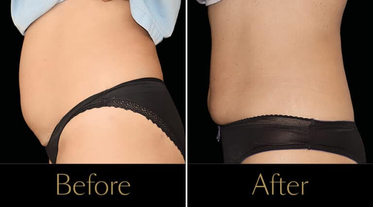 neo-beforeafter7