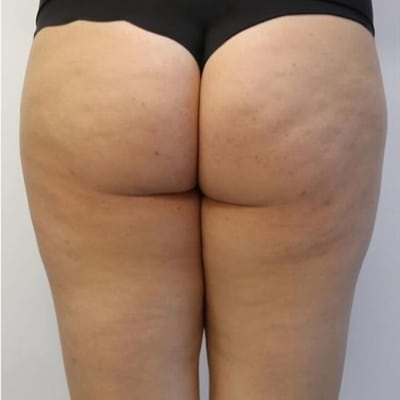 rakus-beforeafter-cellution