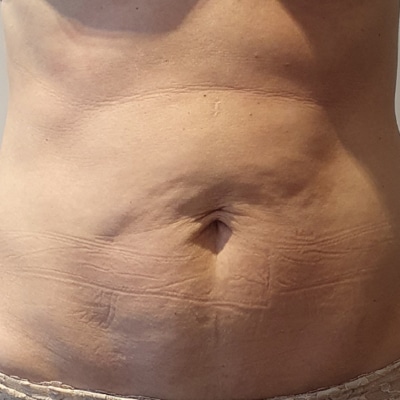 rakus-beforeafter-cellution5