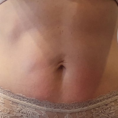 rakus-beforeafter-cellution6