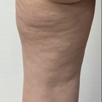 rakus-beforeafter-cellution7