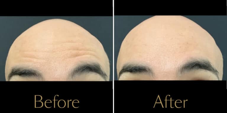 rakus-botox-beforeafter-gallery2