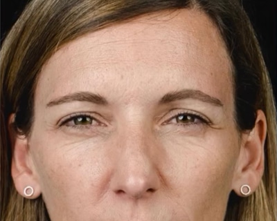 rakus-botox-gallery4