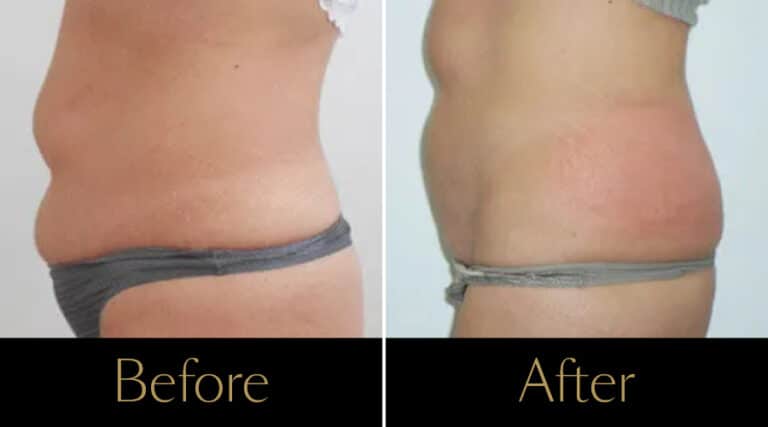 rakus-cristalpro-beforeafter-gallery2