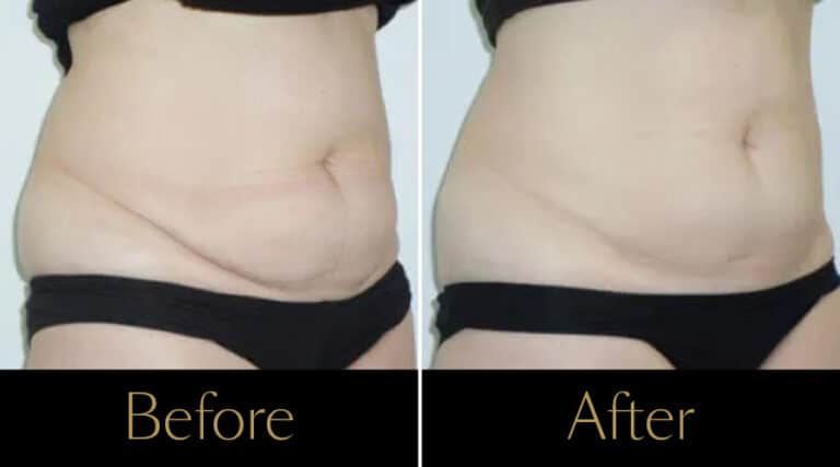 rakus-cristalpro-beforeafter-gallery4