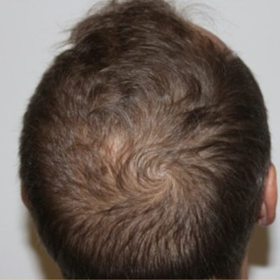 rakus-keravive-beforeafter6