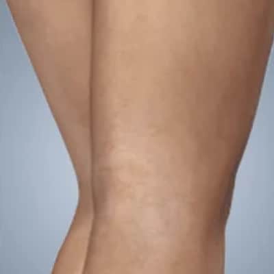 rakus-sclerotherapy-ba2