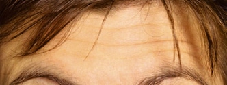 RR_Botox_beforeafter4-Before