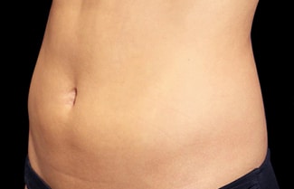 RR_emsculpt_beforeafter4-Before