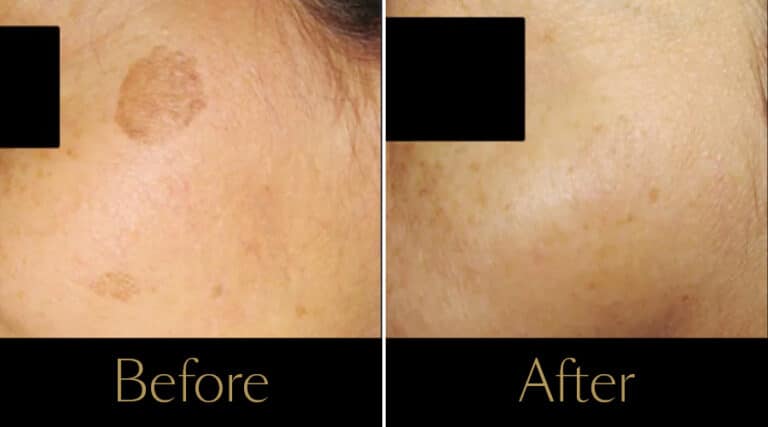 rakus-ipl-beforeafter2