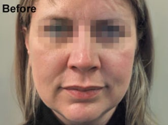 Profhilo-Face-3_before