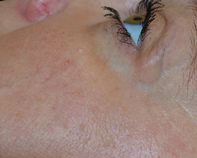 Rakus-Exilis-BAs6