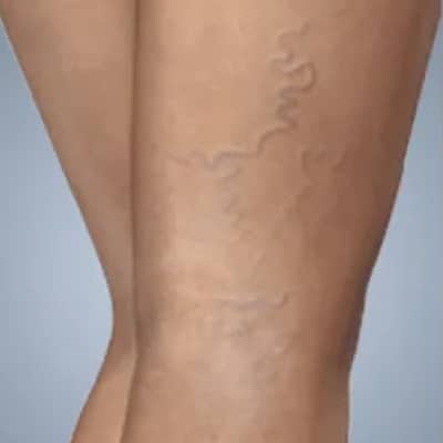 rakus-sclerotherapy-ba
