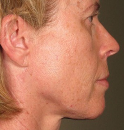 rakus-ultherapy-prime-ba-new2
