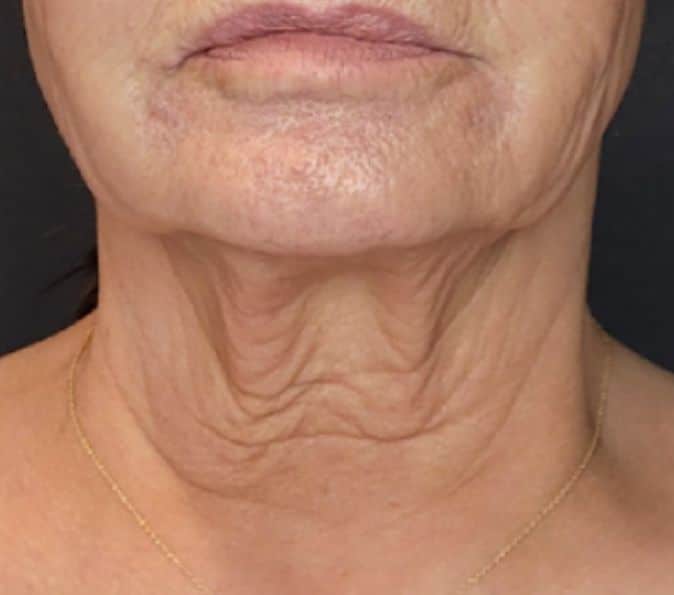 sofwave-Neck-Smile-and-Skin-Before-page-277